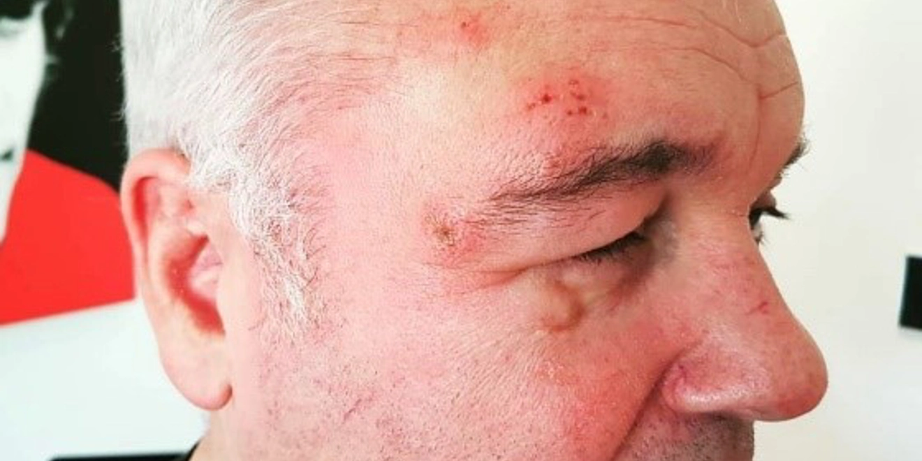 Eamonn Holmes picture of his shingles rash
