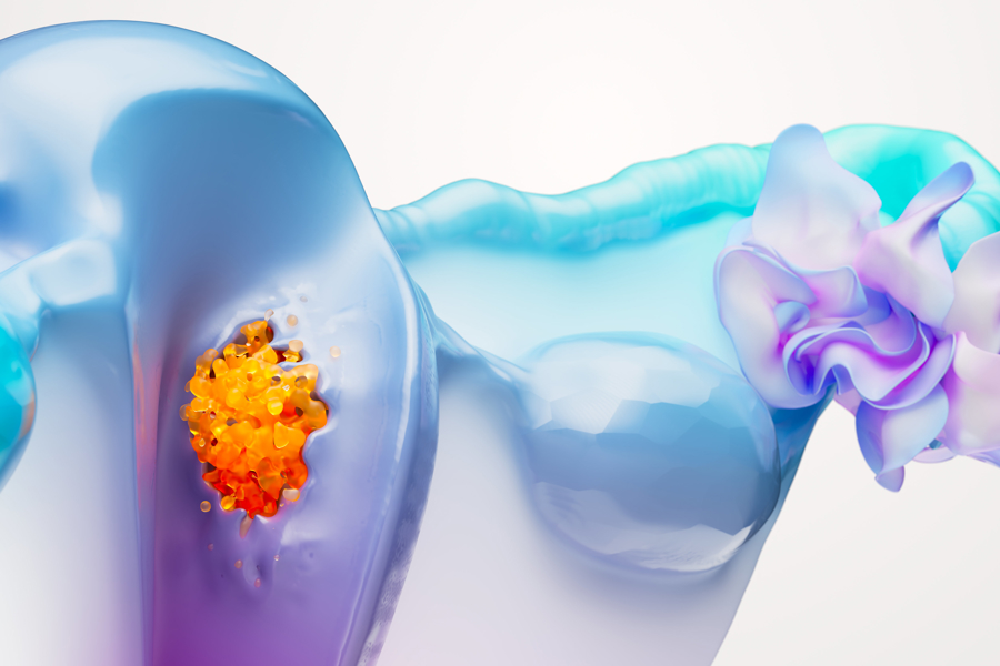 Endometrial Cancer Science Image