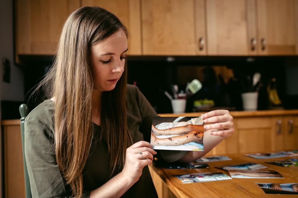 Patient Kate holds up a photograph showing the rash she suffered from on her legs when she had IMD