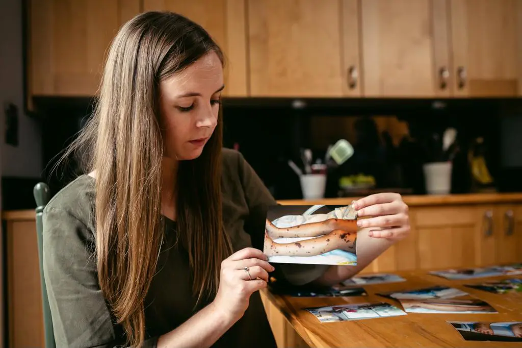 Patient Kate holds up a photograph showing the rash she suffered from on her legs when she had IMD