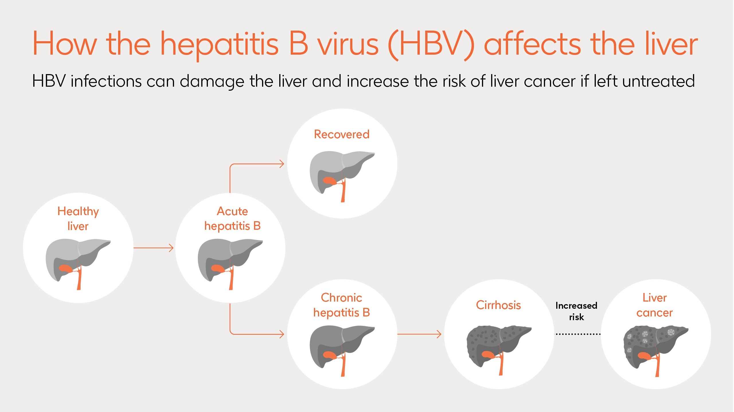 Image demonstrating the possible damage that the hepatitis B virus can do to the liver through cirrhosis and liver cancer