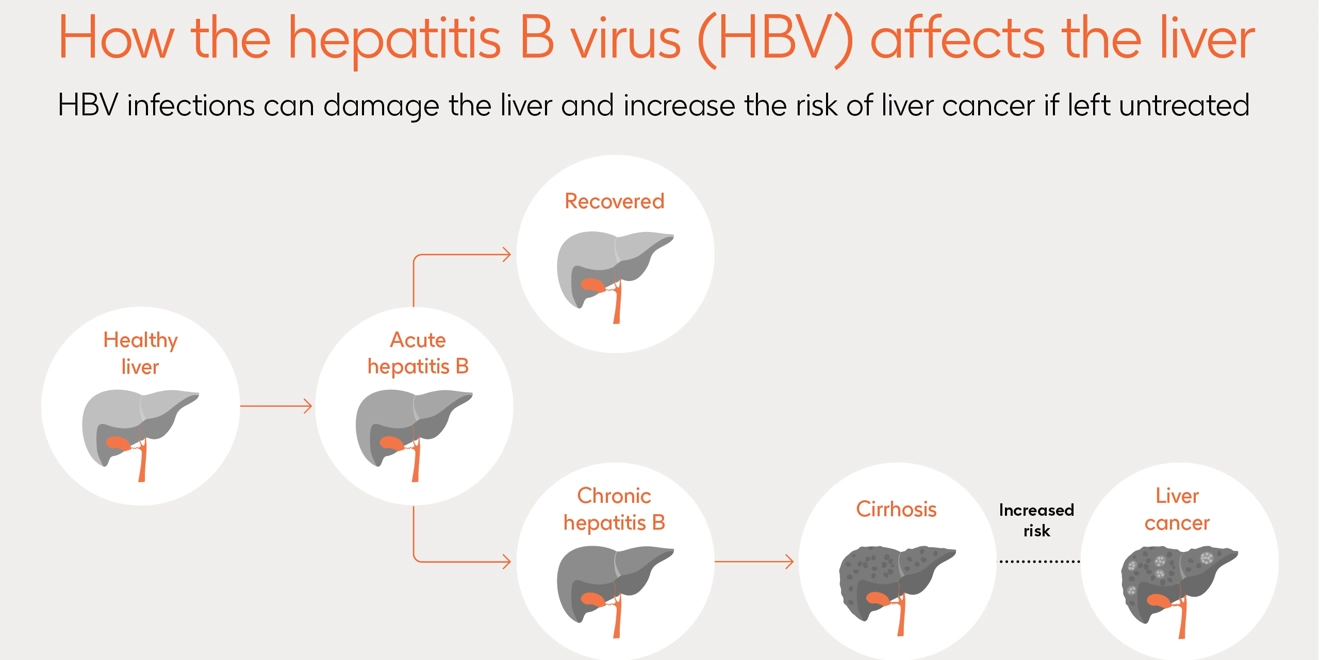 Image demonstrating the possible damage that the hepatitis B virus can do to the liver through cirrhosis and liver cancer