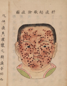 c 1720, Smallpox illustration, Japanese manuscript, Wellcome Collection