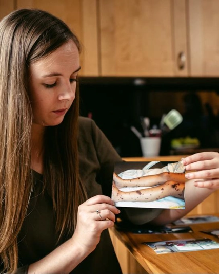 Patient Kate holds up a photograph showing the rash she suffered from on her legs when she had IMD