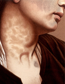 1881, Photographic illustrations of cutaneous syphilis / by George Henry Fox. Wellcome Collection